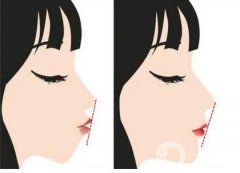 地包天是如何形成的，如何矫正地包天