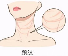 颈部除皱的方法有哪些？