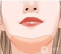 哪些人适合自体软骨垫下巴，特点是什么