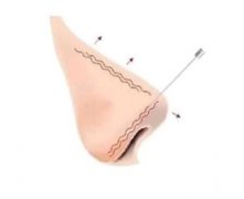 哪种假体适合鼻整形？