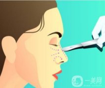 玻尿酸隆鼻后鼻翼越来越宽怎么办？