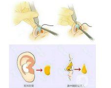 耳软骨垫鼻尖可以捏吗？多长时间才能恢复
