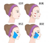 多维拉面部提升手术和埋线提升手术的区别