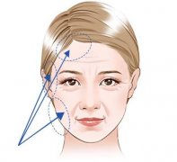 电波拉皮有什么优势？作用是什么