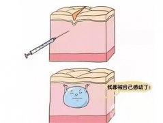 玻尿酸可以注射过量吗？