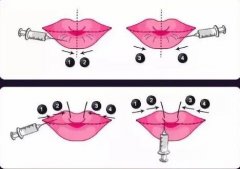 玻尿酸丰唇珠有哪些优点，效果可以维持多久