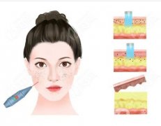 点阵激光缩小毛孔效果如何？