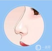 大蒜鼻整形需要多少钱