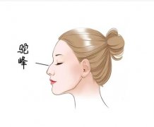 矫正驼峰鼻有哪些优点和缺点