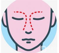 鼻部整形修复需要更换假体吗