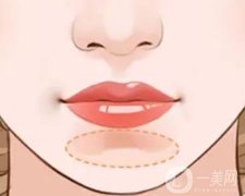 玻尿酸注射下巴需要几天才能减少肿胀？