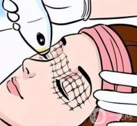 超声刀可以去眼部皱纹吗？