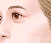 激光去除鱼尾纹怎么样，有副作用吗