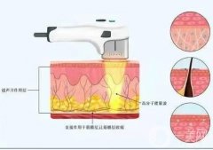 超声波手术刀抗衰老的重点是什么？
