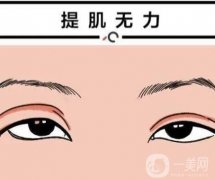 上睑下垂手术有哪些后遗症？