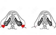 鼻基底填充手术的过程是怎样的