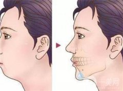 玻尿酸垫下巴有什么副作用？