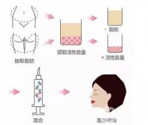 自体脂肪填充泪沟有哪些注意事项