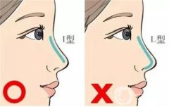 鼻综合手术能持续多久？有什么后遗症