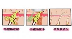 果酸换肤有什么危害，如何避免