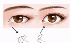 可以经常做热玛吉吗