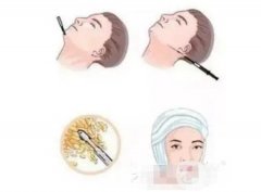 面部吸脂有哪些副作用，皮肤会松弛吗