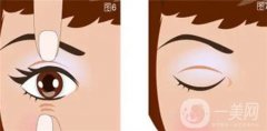 埋线双眼皮手术后出现感染怎么办？