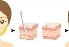 面部吸脂和溶脂注射的区别是什么