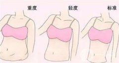 抽脂手术可以做几次