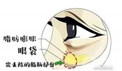 去眼袋手术有哪些常见风险？