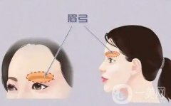 切眉手术安全吗，适合什么年龄