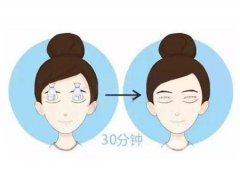 双眼皮手术后应该避免哪些食物