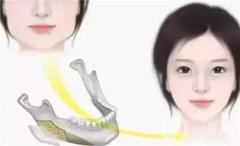 下颌角截骨术后需要多长时间才能恢复