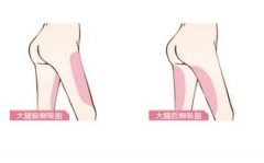 腿部吸脂适合哪些部位？