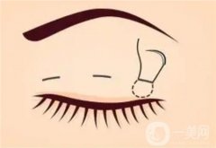 定点双眼皮手术效果能维持多久？