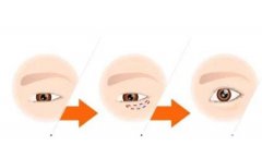 手术去眼袋有什么优点