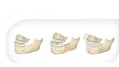 骨性凸嘴需要正颌手术吗？