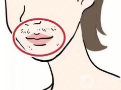 激光脱毛后毛发还会再长出来吗？