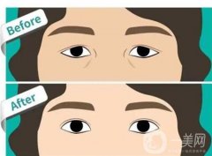 埋线双眼皮后的浮肿如何快速消肿