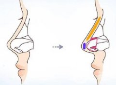 哪种假体隆鼻材料好？