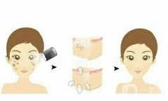 激光祛斑效果怎么样？要注意什么