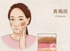 激光祛痘印后会复发吗？