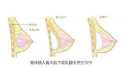 隆胸后有哪些事项需要注意