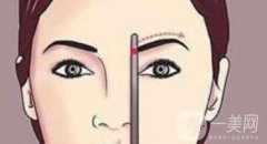 仿生植眉的方法有几种