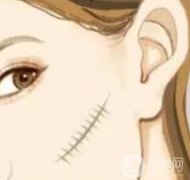 如何预防烧伤后留下疤痕