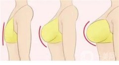 乳头再造的方法有哪些？