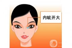 开眼角术后的护理方法有哪些？