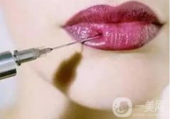 自体脂肪填充丰唇是永久性的吗