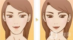 玻尿酸垫下巴怎样才能快速恢复？