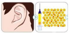 玻尿酸丰耳垂有何特点，有什么效果